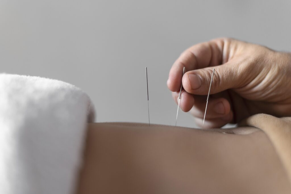 Can Acupuncture Help With Weight Loss- Top 5 Secrets