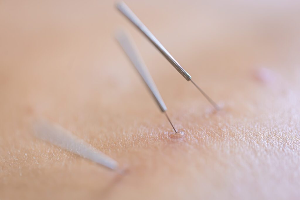 Can Acupuncture Help With Weight Loss in 2024